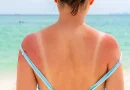 escaldão queimadura solar