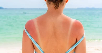 escaldão queimadura solar